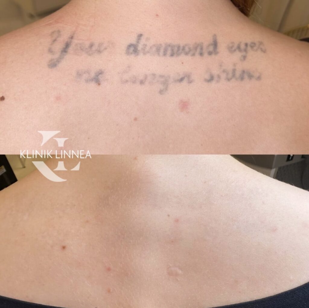 Tatuoinninpoisto laserilla