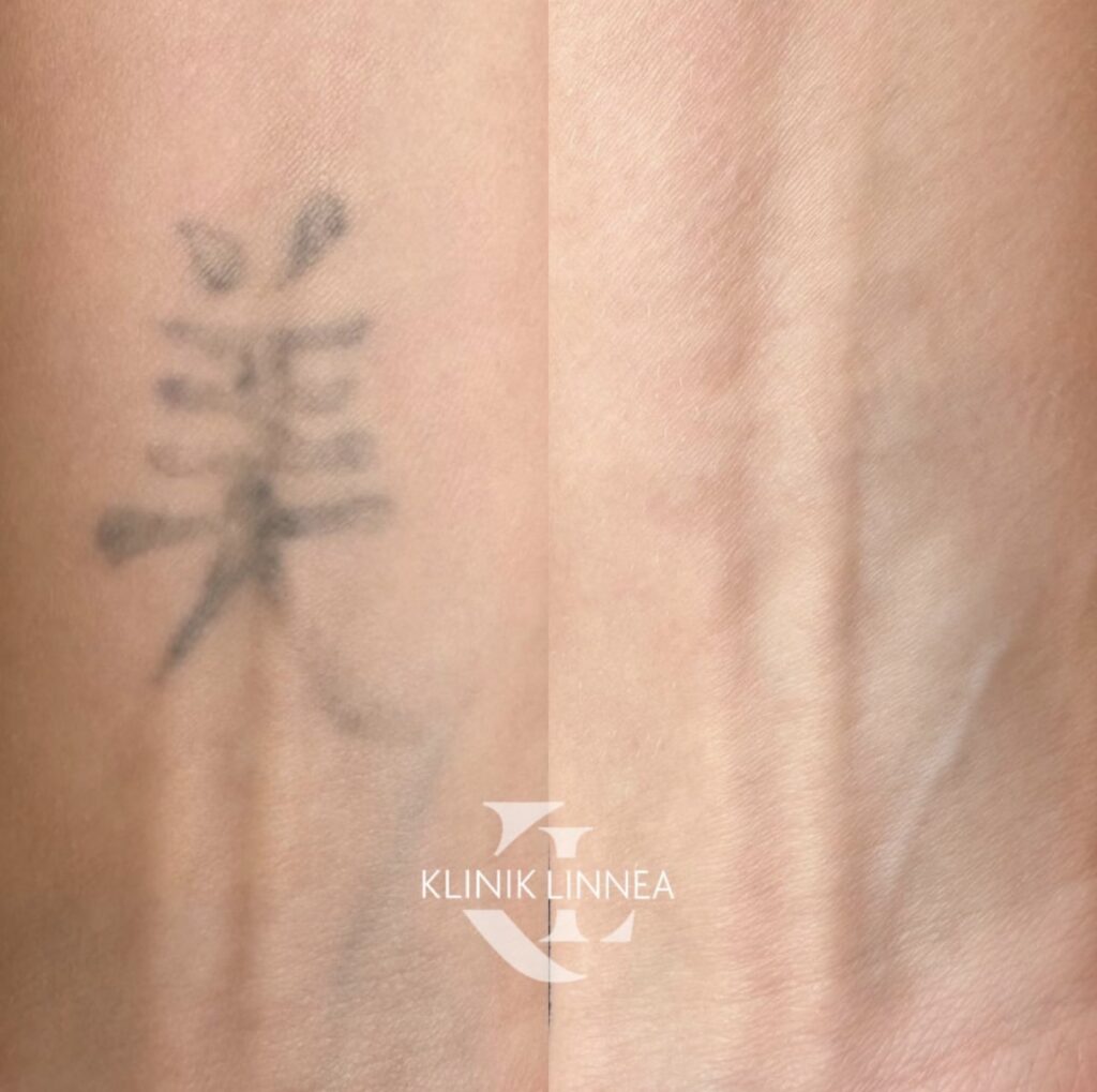 Tatuoinninpoisto laserilla