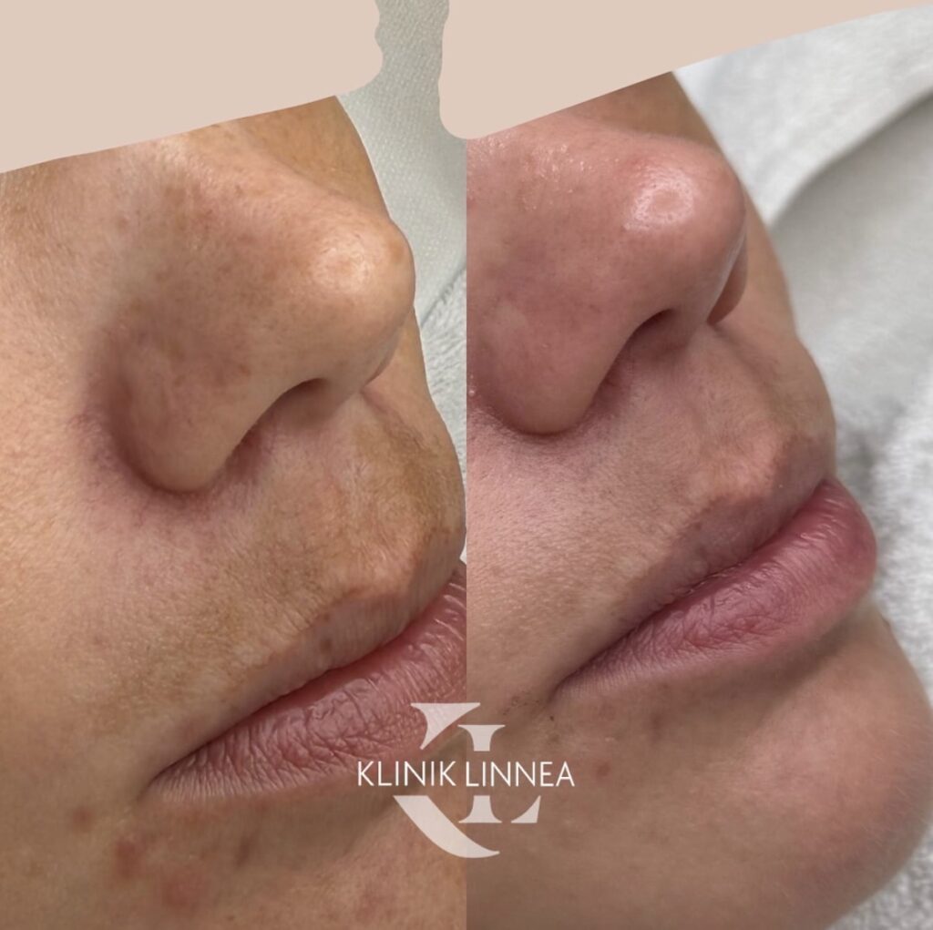 Lumecca IPL -valoimpulssihoito
