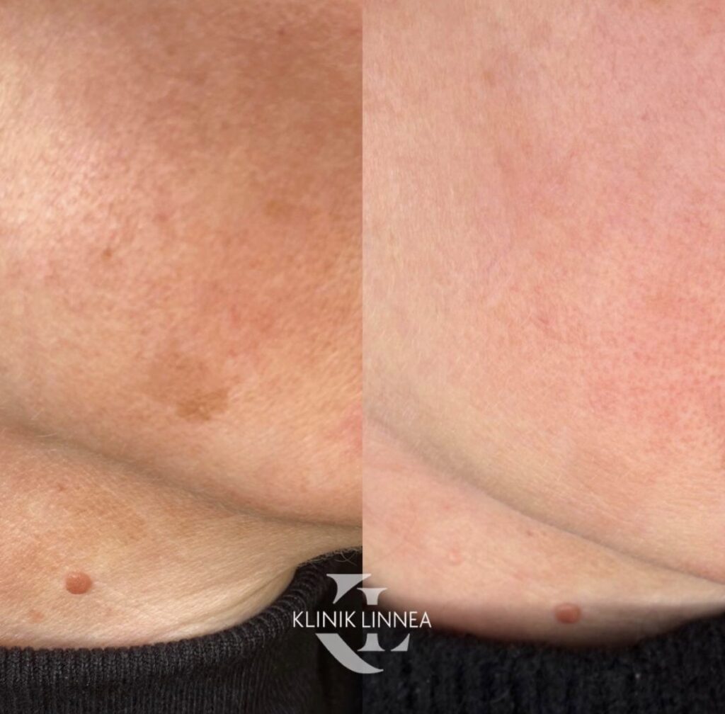 Lumecca IPL -valoimpulssihoito