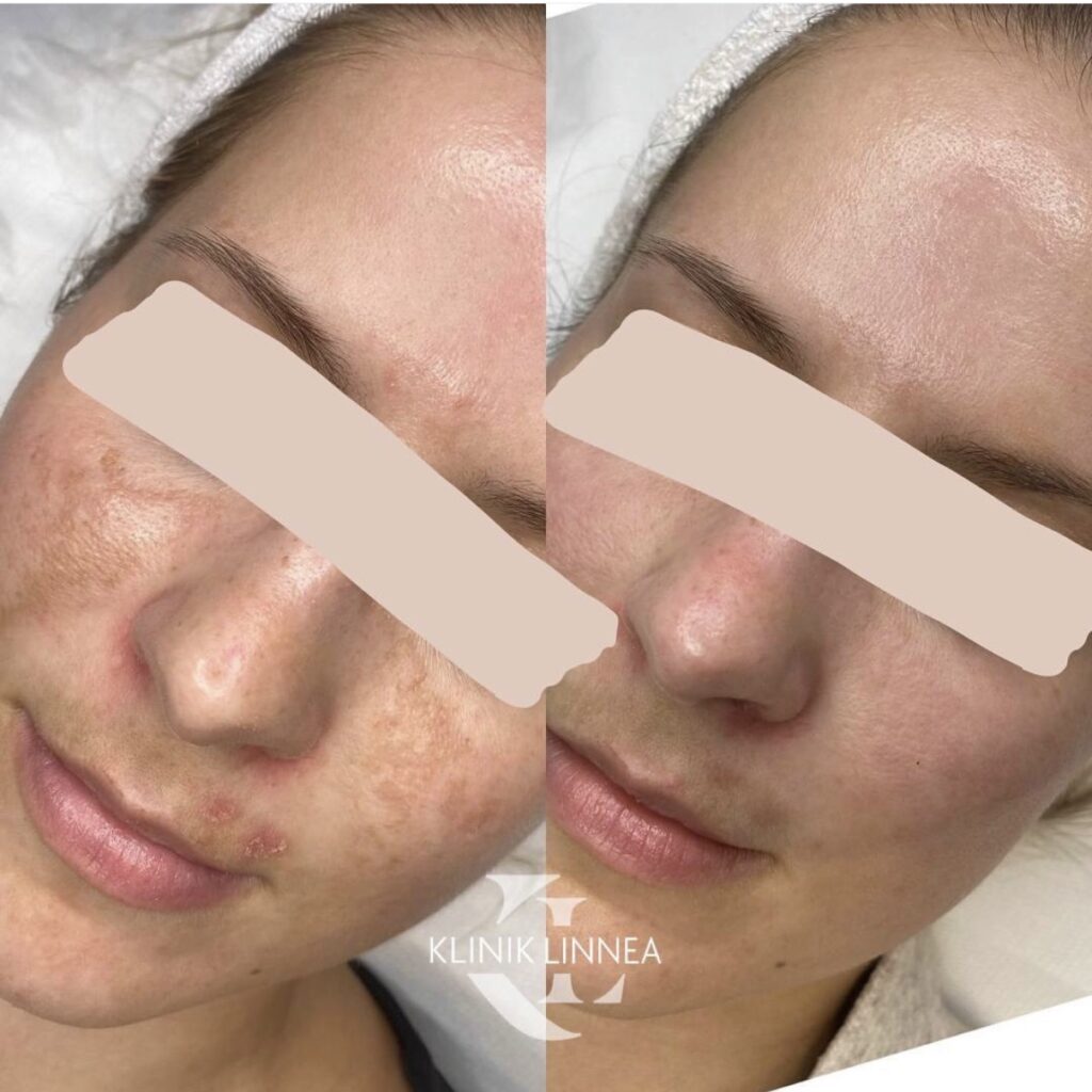 Lumecca IPL -valoimpulssihoito