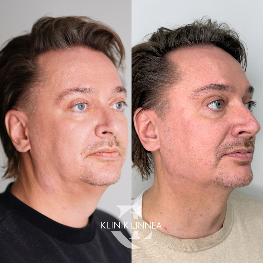 Chin liposuction