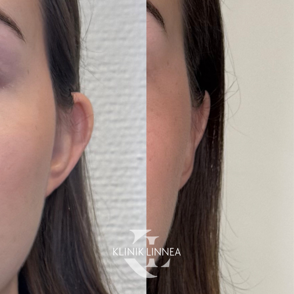 Hörökorvaleikkaus (Otoplastia)