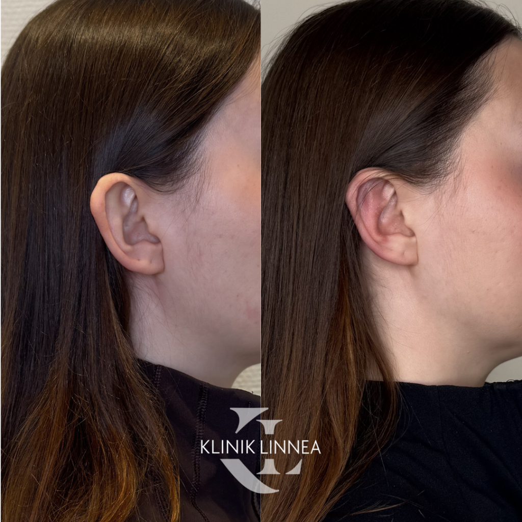 Hörökorvaleikkaus (Otoplastia)