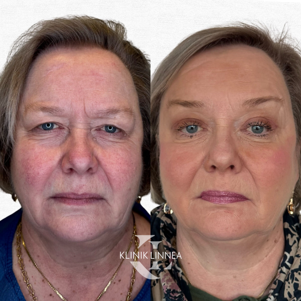 Brow lift