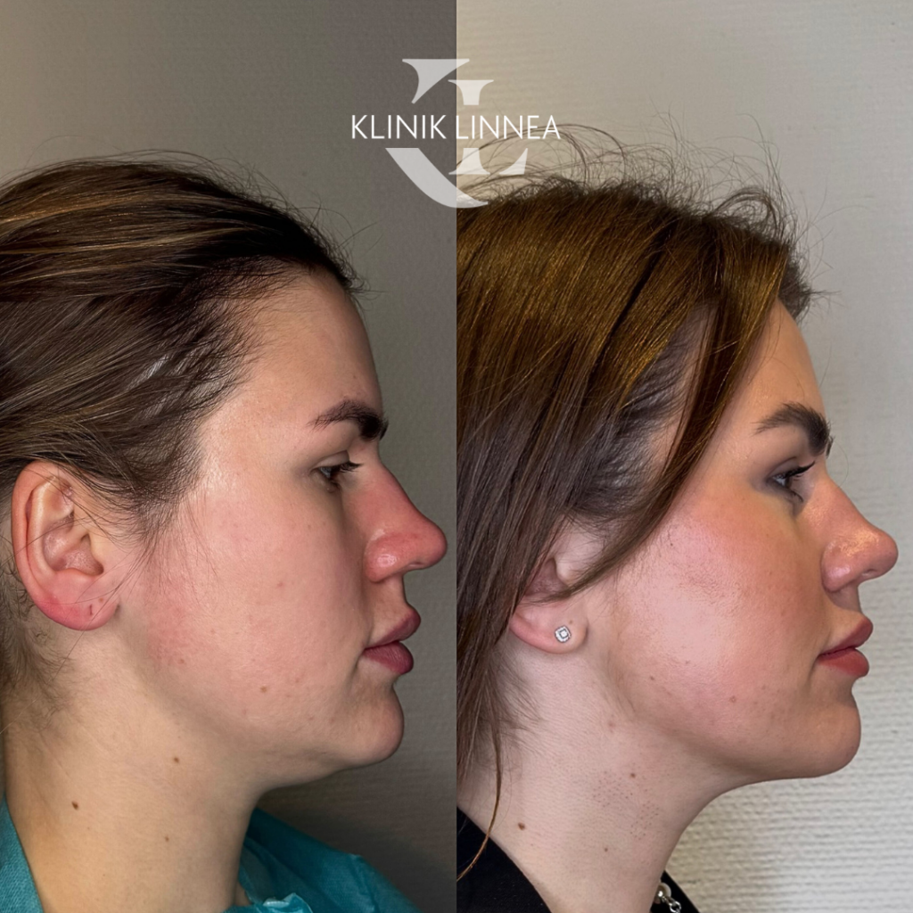 Chin liposuction