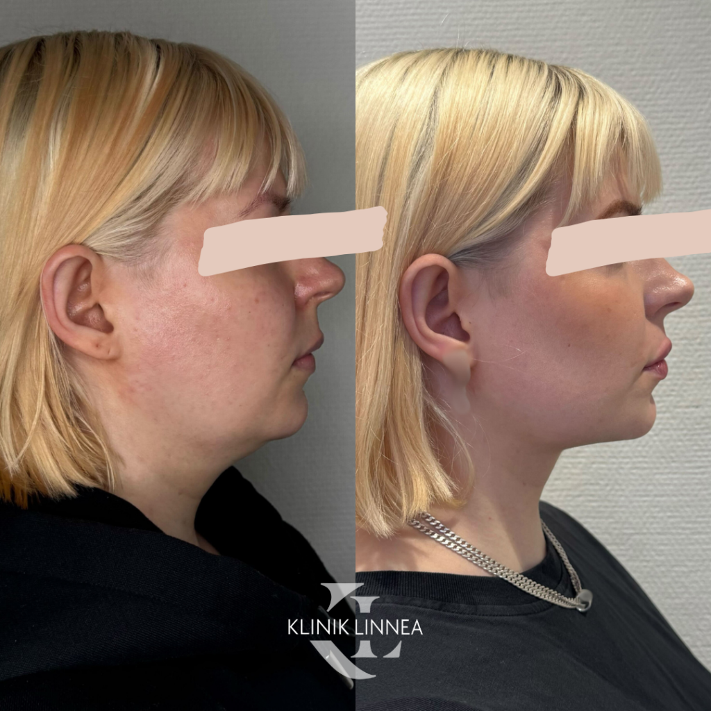 Chin liposuction
