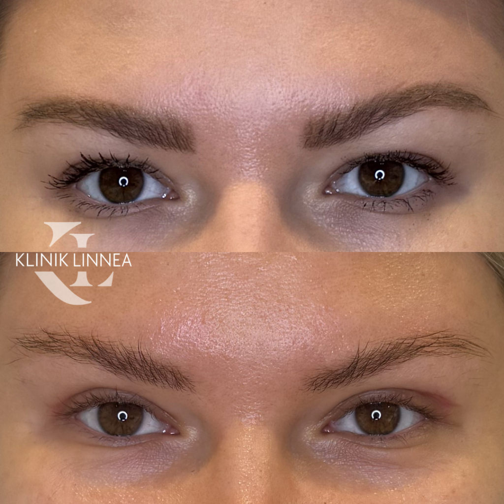 Upper eyelid surgery, blepharoplasty