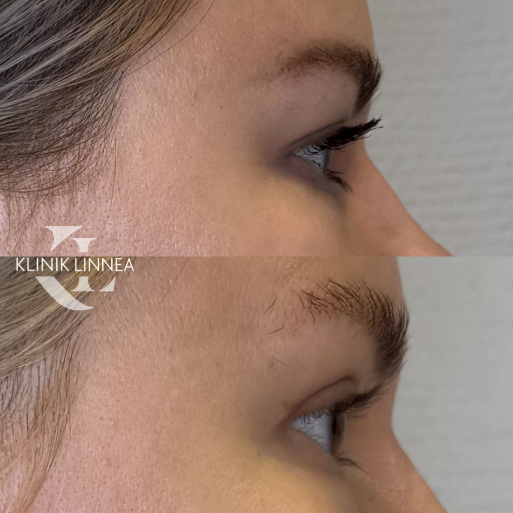 Upper eyelid surgery, blepharoplasty