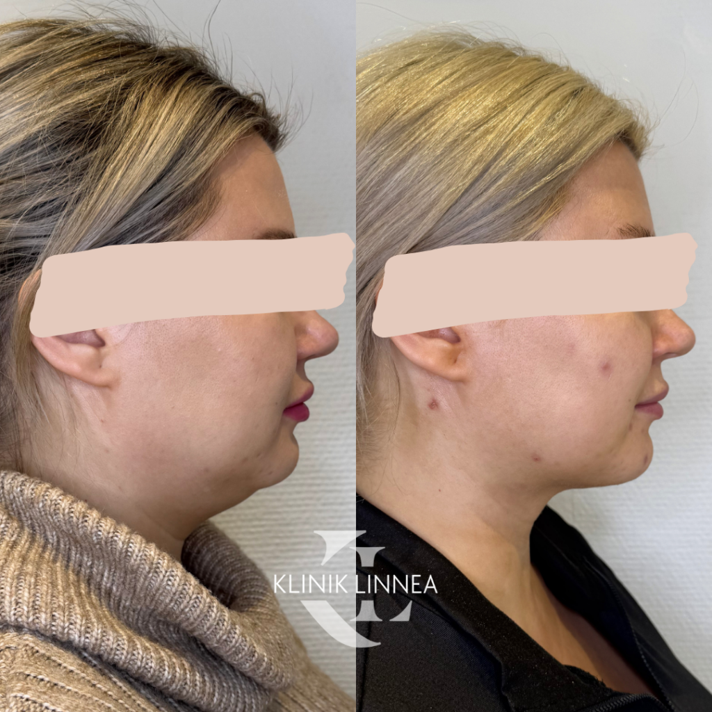 Chin liposuction