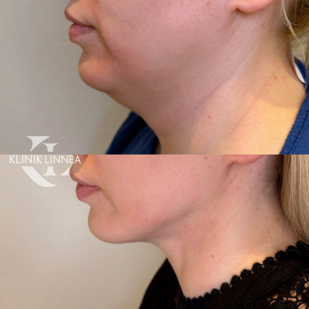 Chin liposuction