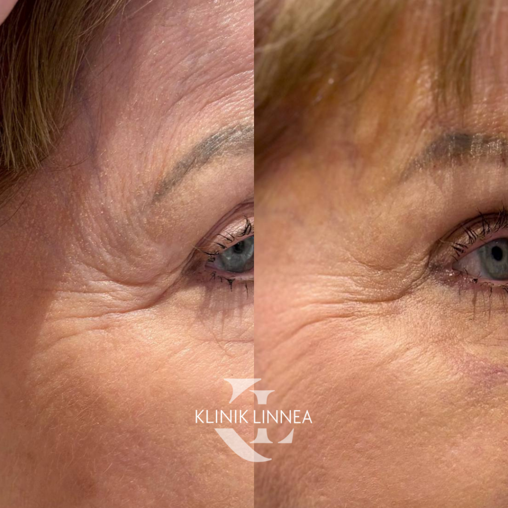 Brow lift